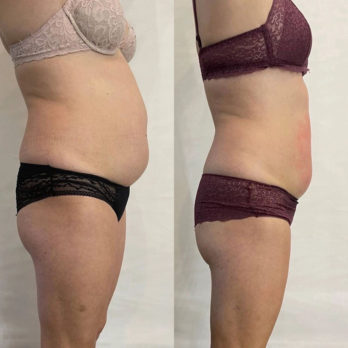 Healthflow Lymphatic Drainage